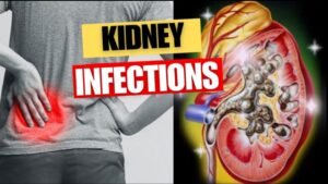 Read more about the article Kidney Infections