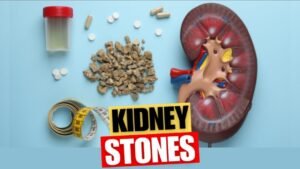 Read more about the article Kidney Stones