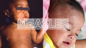 Read more about the article Measles: A Highly Contagious but Preventable Disease