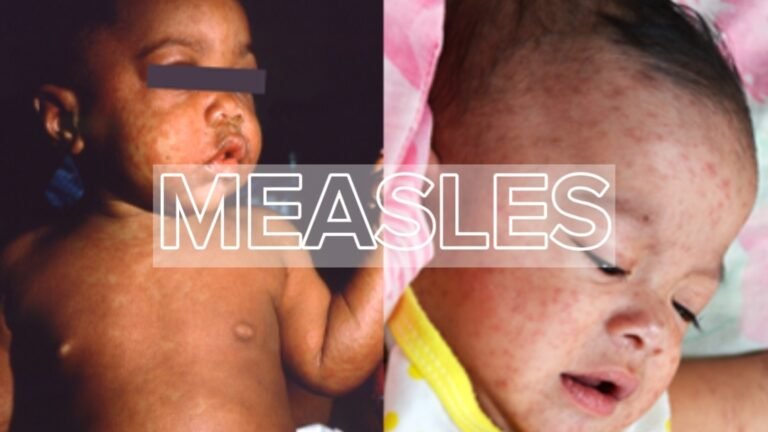 Measles