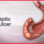 Peptic Ulcers: Causes, Symptoms, and Treatment