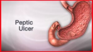 Read more about the article Peptic Ulcers: Causes, Symptoms, and Treatment