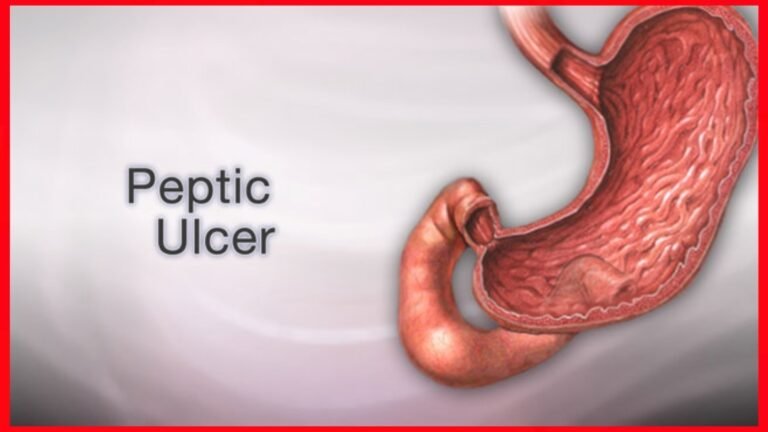 Peptic Ulcer